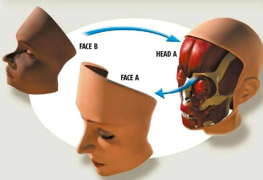 Face transplantation