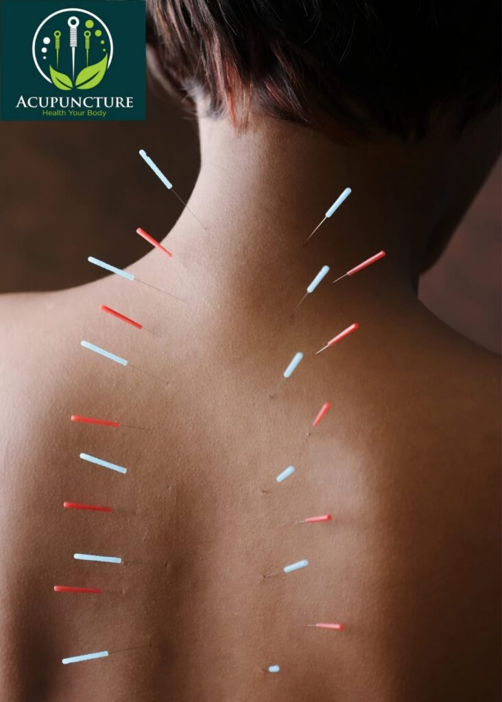 Acupuncture
